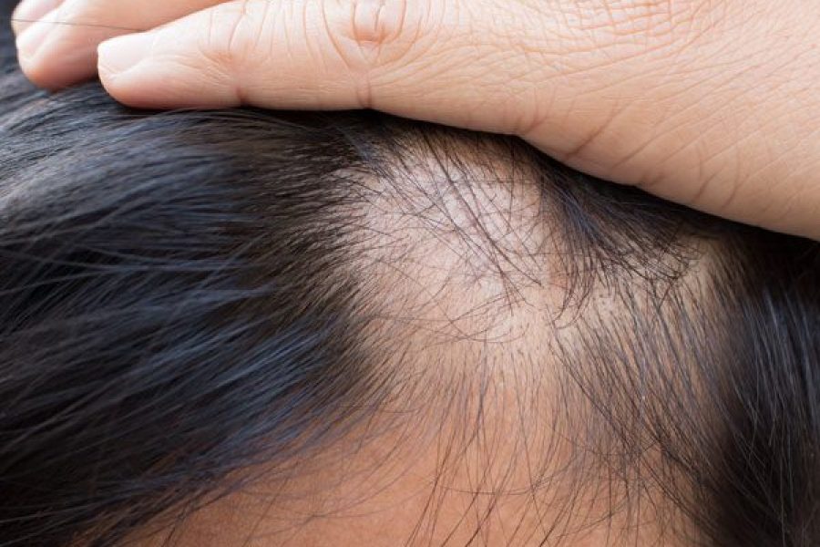 Causes Of Hair Loss
