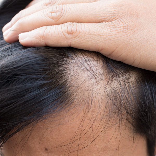 Causes Of Hair Loss