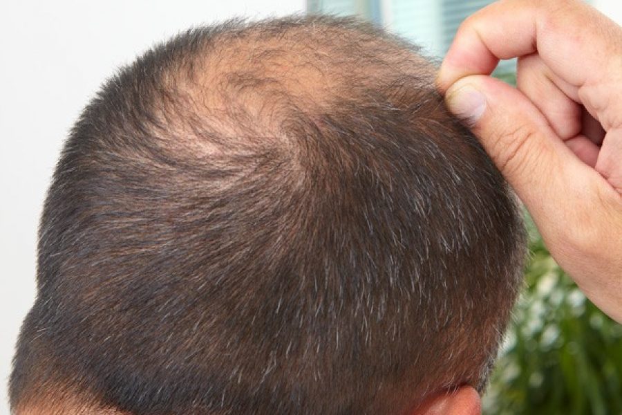 Your Genes and Hair Loss