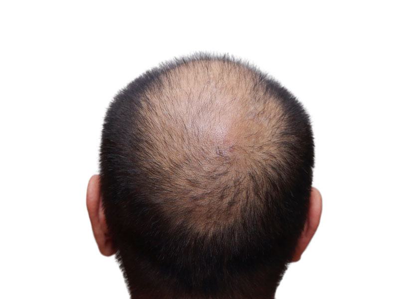 Hair Replacement Surgery Toronto