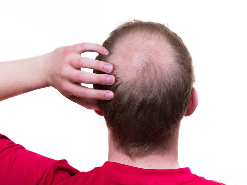 Hair Replacement Surgery Toronto Hair Replacement Surgery Toronto