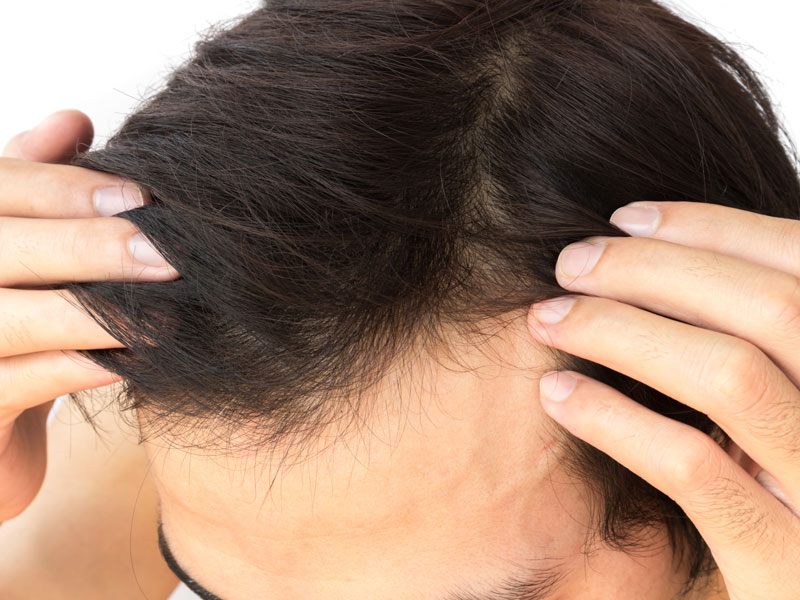 Hair Restoration Toronto