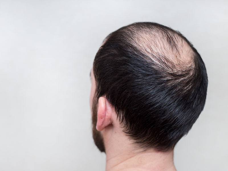 Hair Loss Treatment Toronto