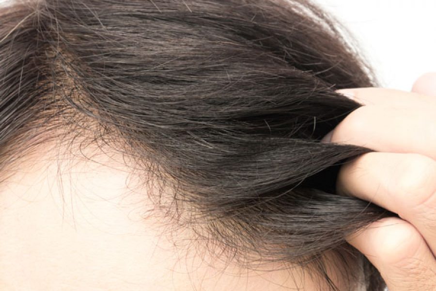 Dry Scalp And How It Relates To Hair Loss