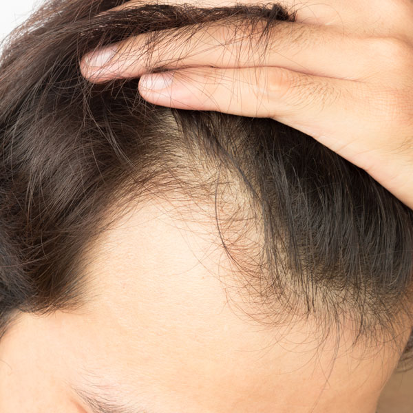 Temporary Hair Loss | Toronto Hair Transplant Clinic