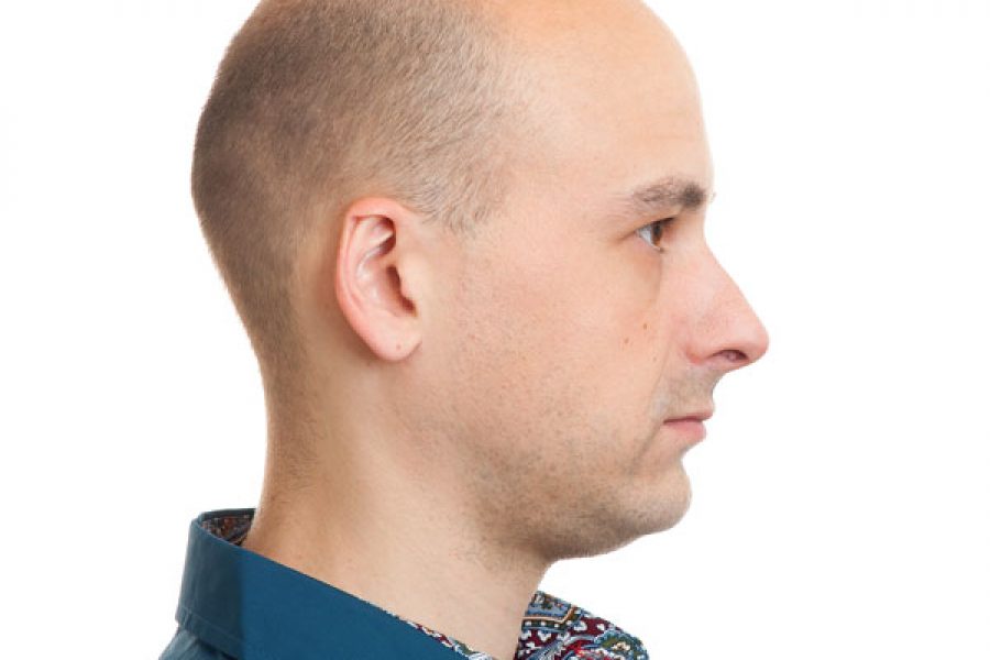 Genetic Causes Of Hair Loss Among Men
