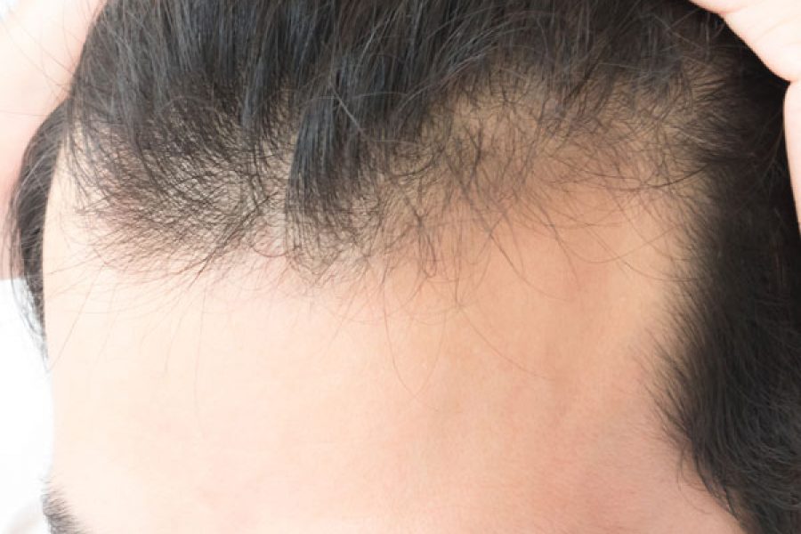 Steroids And How They Affect Hair Loss