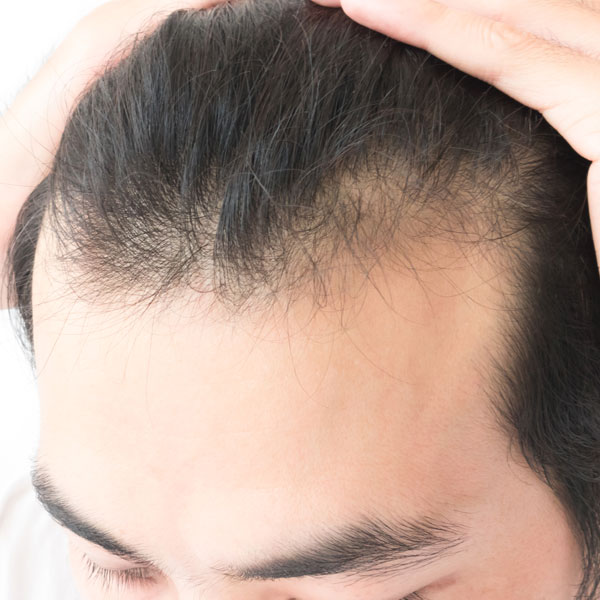 Steroids And How They Affect Hair Loss | Toronto Hair Transplant Clinic