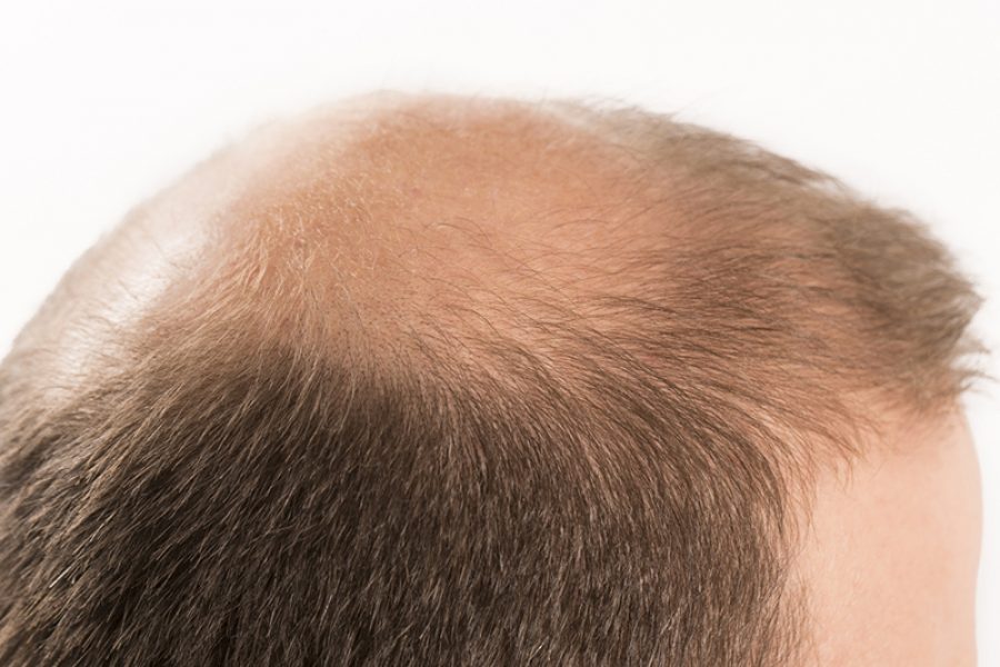 Alopecia: It Means Hair Loss