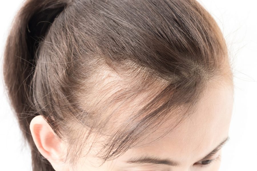 How Your Genes Affect Your Hair Loss