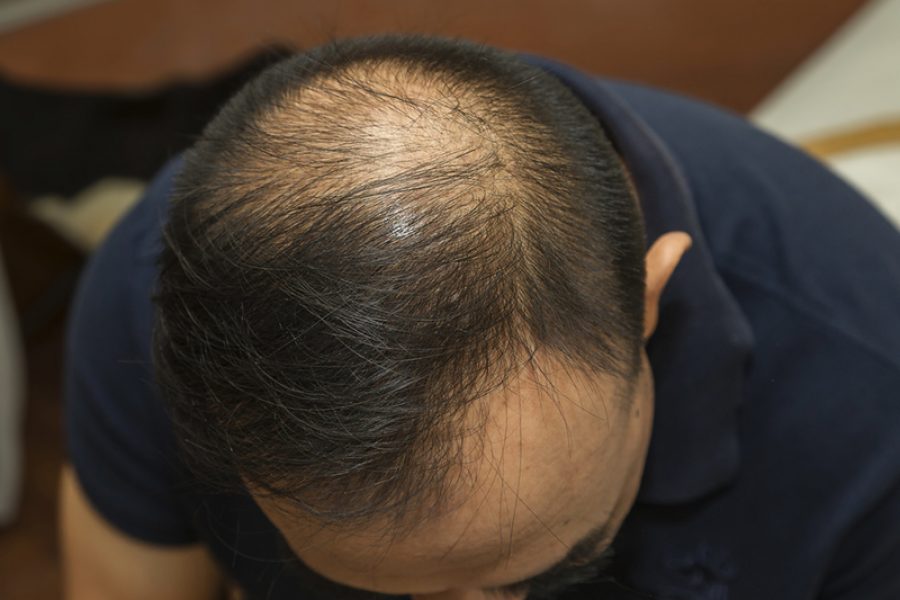 Is It Possible To Have A Successful Hair Transplant In Toronto With A Norwood 6-7 Stage Hair Loss?