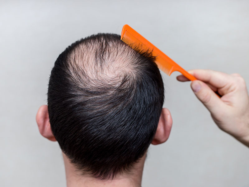 Aging And Hair Loss