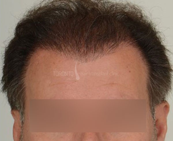 Hair-Transplant-Toronto-2-3 - The Toronto Hair Transplant Clinic