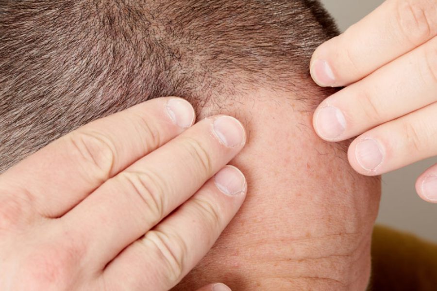 Effluvium: Another Type Of Hair Loss