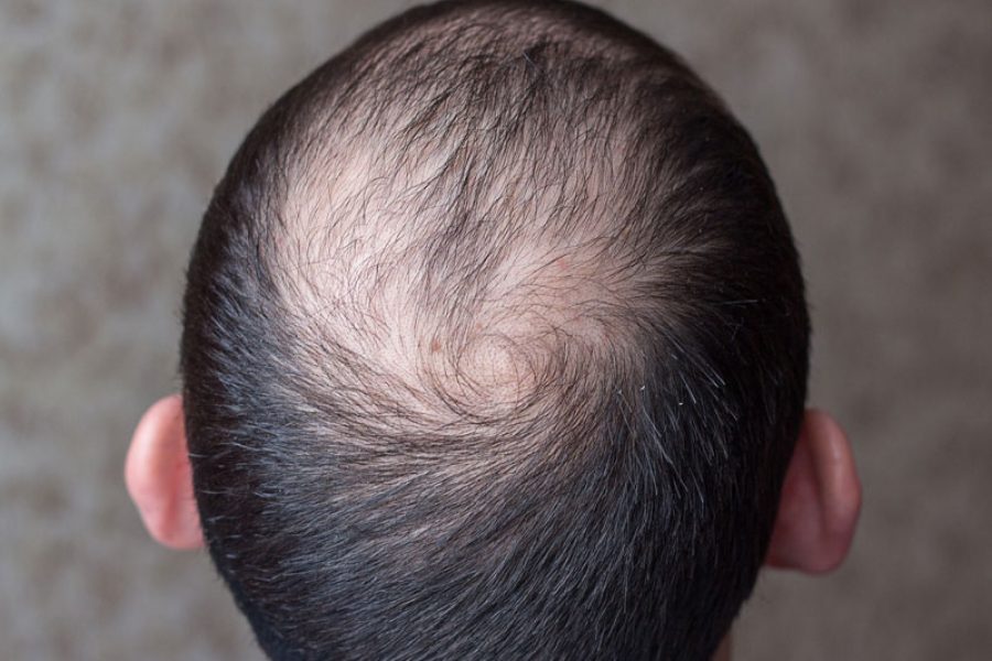 Hair Loss Caused By Infections