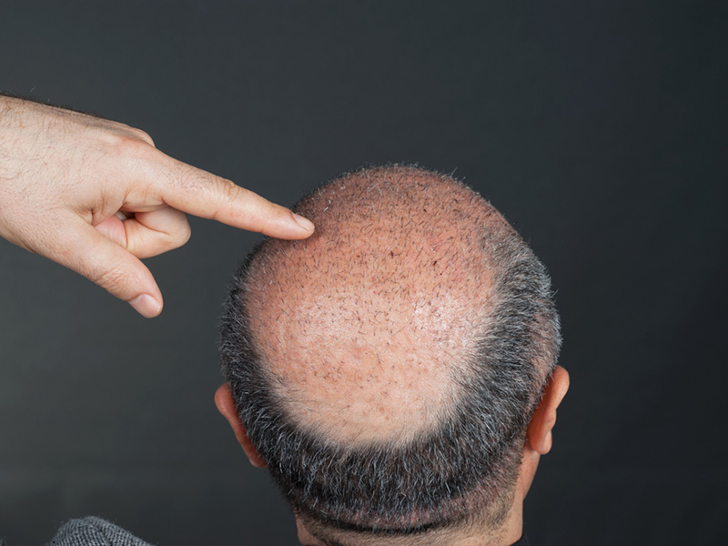 SMP - Scalp Micropigmentation (hair follicle tattoo) - Bournemouth Permanent  Makeup