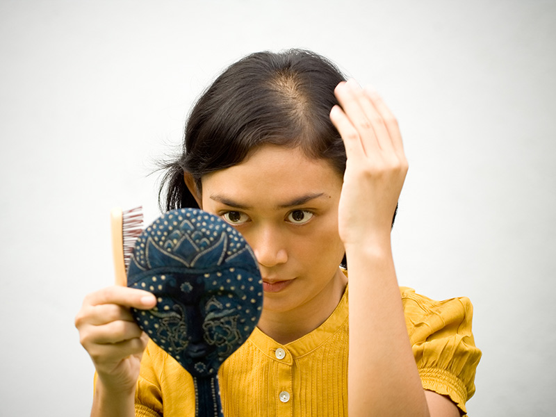 DHT and Hair Loss-2 DHT and Hair Loss