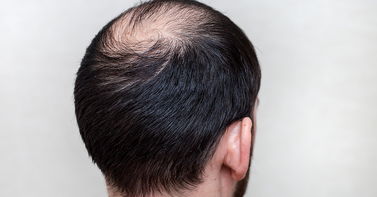 DHT And Hair Loss | Hair Restoration In Toronto - Hair Transplant Toronto
