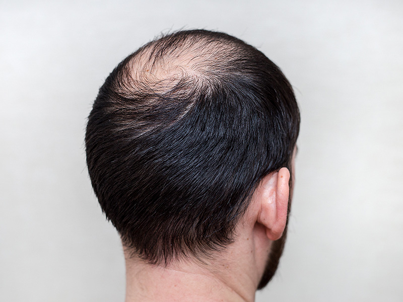 DHT And Hair Loss | Hair Restoration In Toronto - Hair Transplant Toronto
