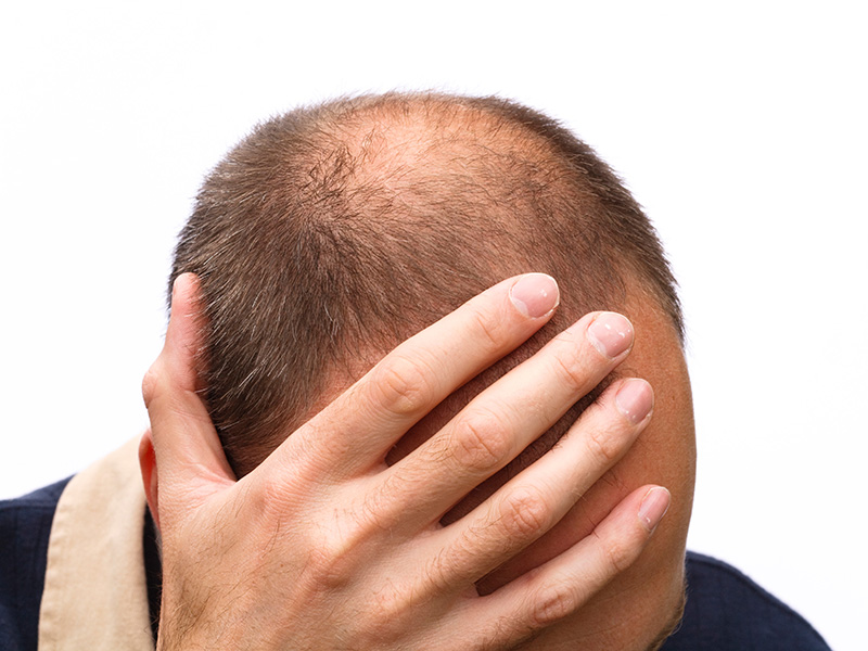 Hair Loss is in Your Genes - Part 1