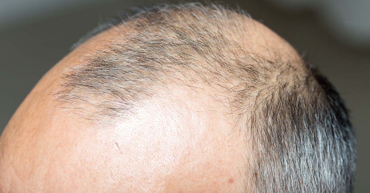 The Background Of Hair Transplantation - Hair Transplant Toronto