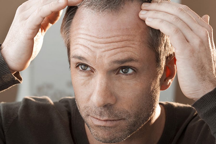 The Psychology of Male Hair Loss