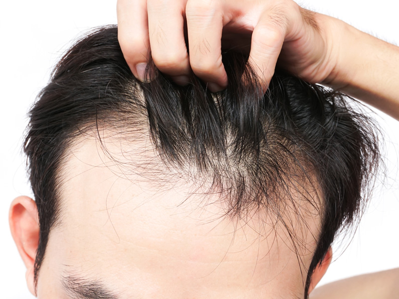 What Is a Hair Transplant-2 What Is a Hair Transplant