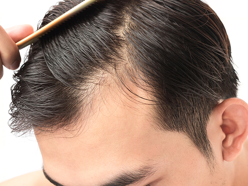 Hair Transplant Reversal