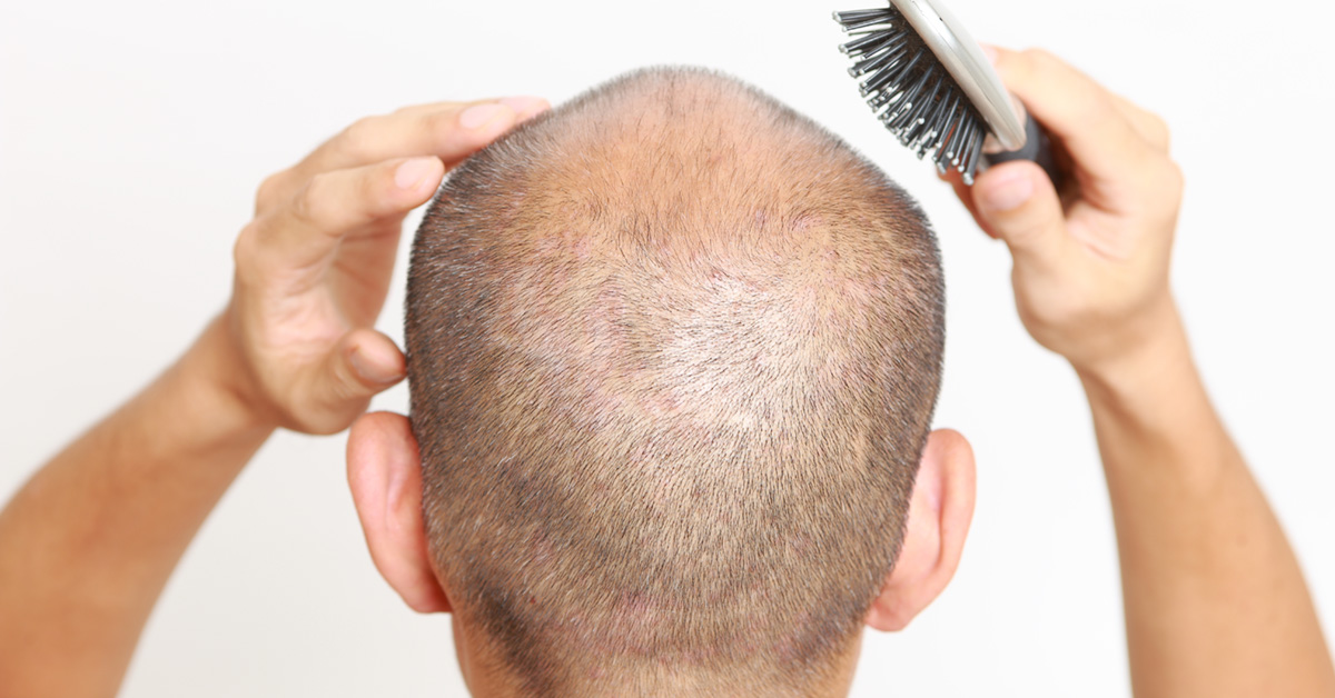 Does Hair Grow Back in the Donor Area After an FUE Hair Transplant  Treatment?