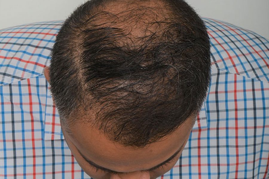 Patient 9 - The Toronto Hair Transplant Clinic