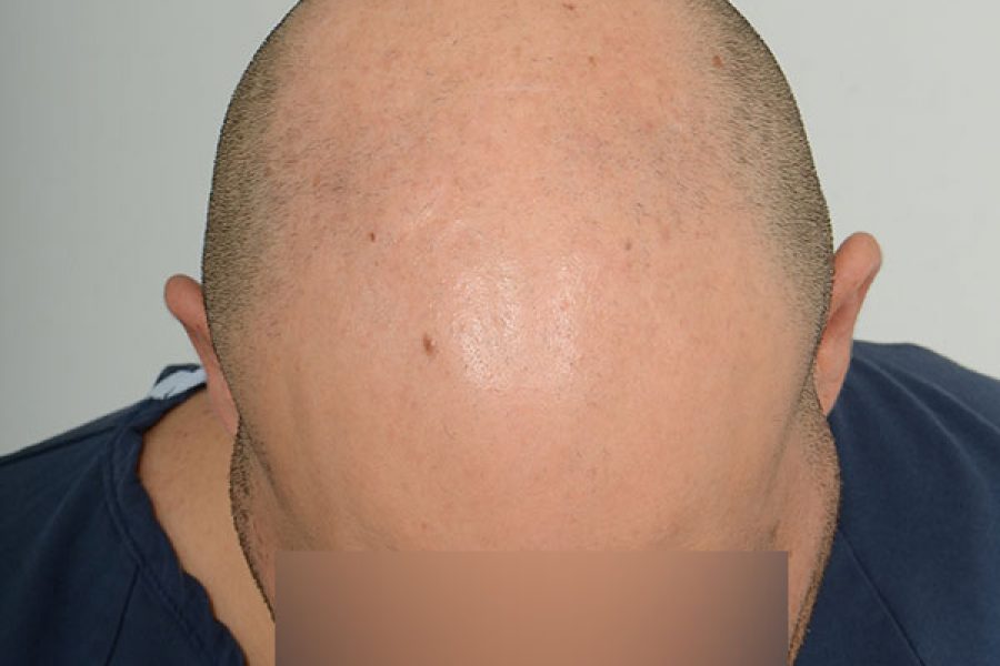 Patient 7 - The Toronto Hair Transplant Clinic