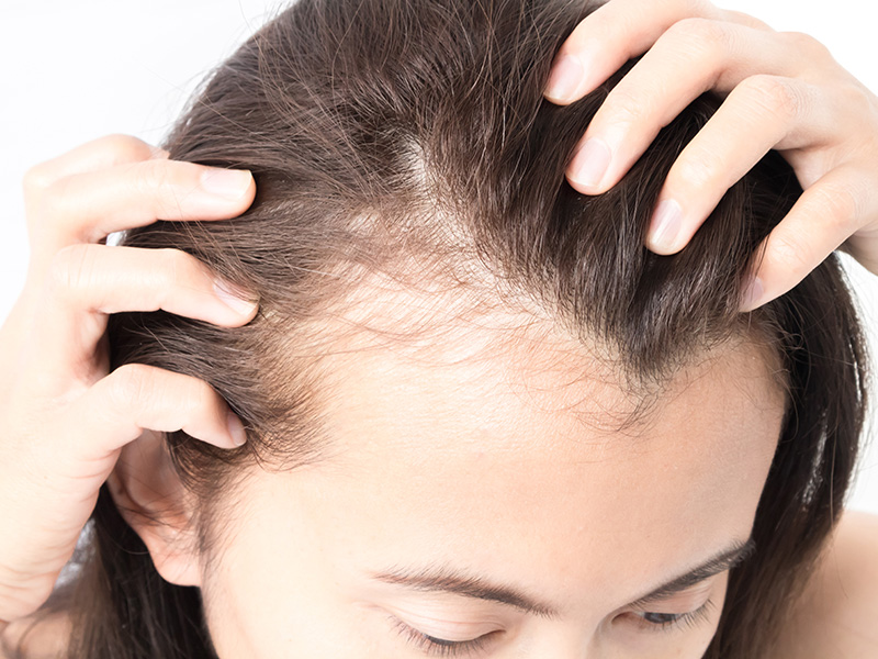 Hair Transplant Reversal Options-2 Hair Transplant Reversal Options