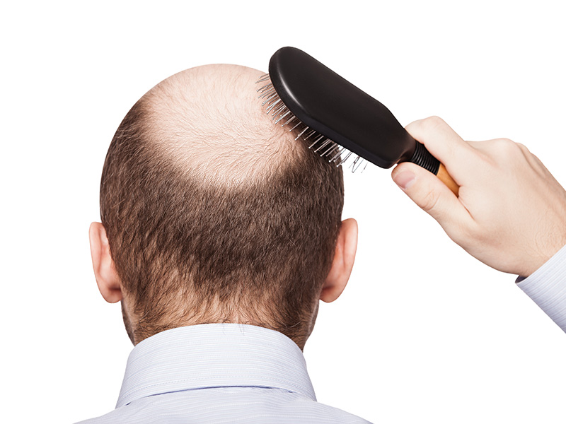 Using Scalp Micropigmentation As An Alternate Hair Loss Solution To Thinning Hair