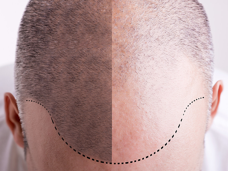 Using Scalp Micropigmentation As An Alternate Hair Loss Solution To Thinning Hair