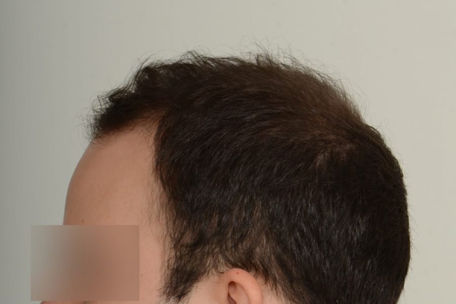 Patient 12 - The Toronto Hair Transplant Clinic