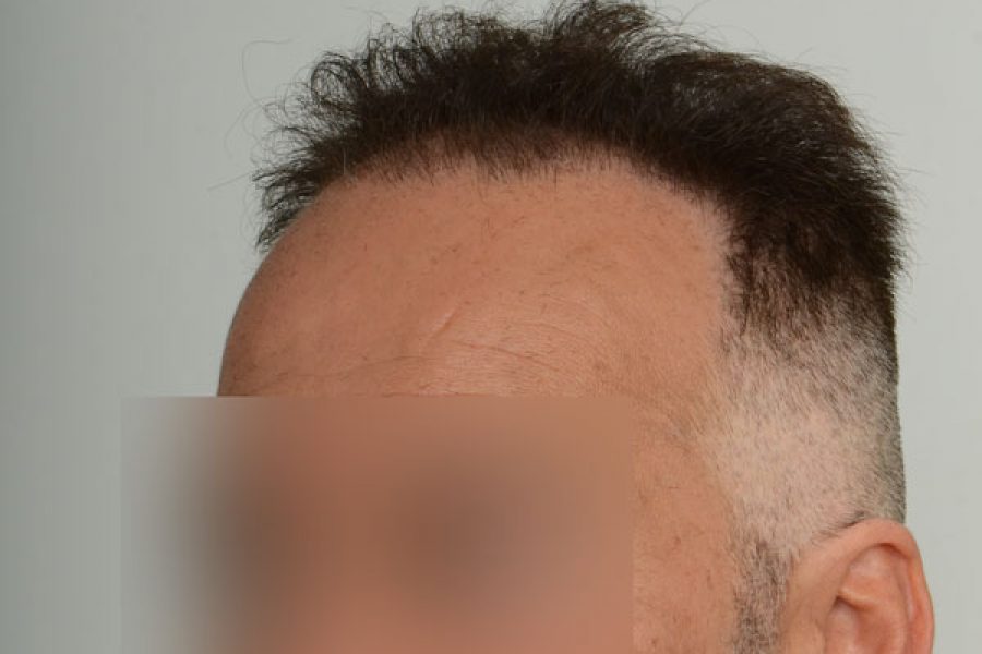 Patient 16 - The Toronto Hair Transplant Clinic