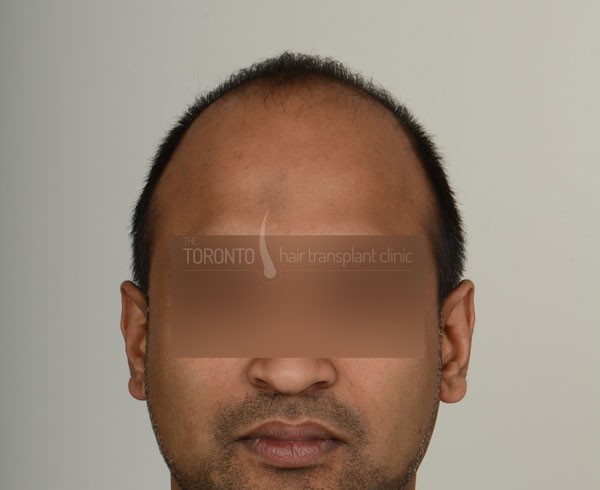 before-after Archives - Page 2 of 4 - The Toronto Hair Transplant Clinic