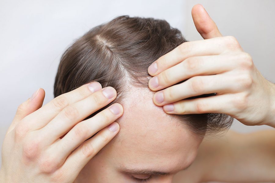 Hair Loss in Toronto? Here’s How to Take Control of Your Hairline