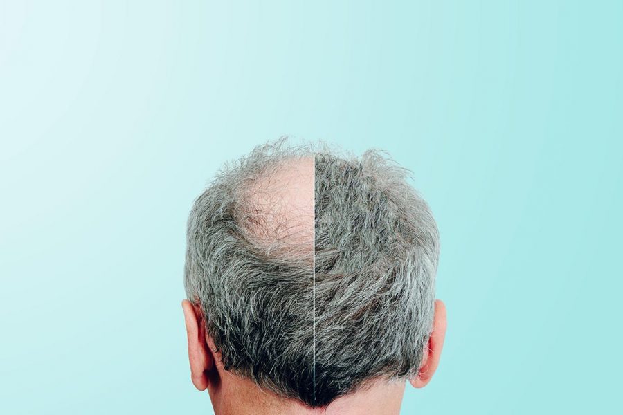 Get the Best FUE Hair Transplant Results