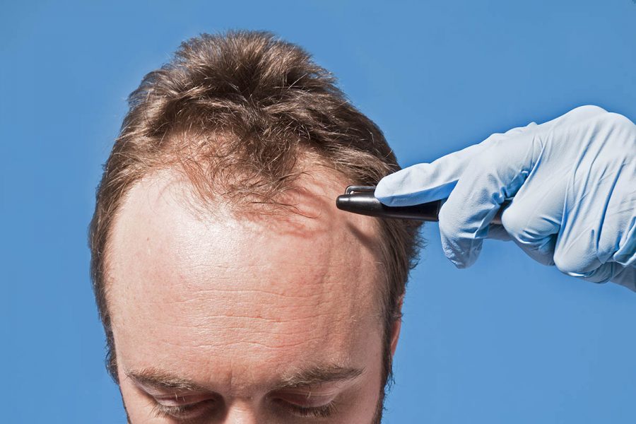 Hair Transplant in Toronto: Do You Know the Truth About Ideal Patient Age?
