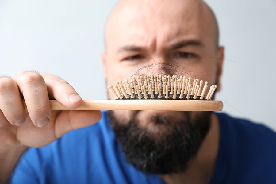 How Can You Tell if You Need an FUE Hair Transplant? [Take the Quiz]