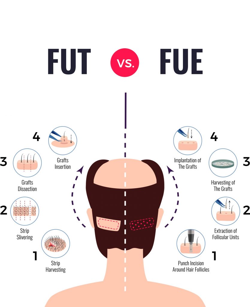 Is FUE Hair Transplant Permanent Here s What Realistic Surgeons Say