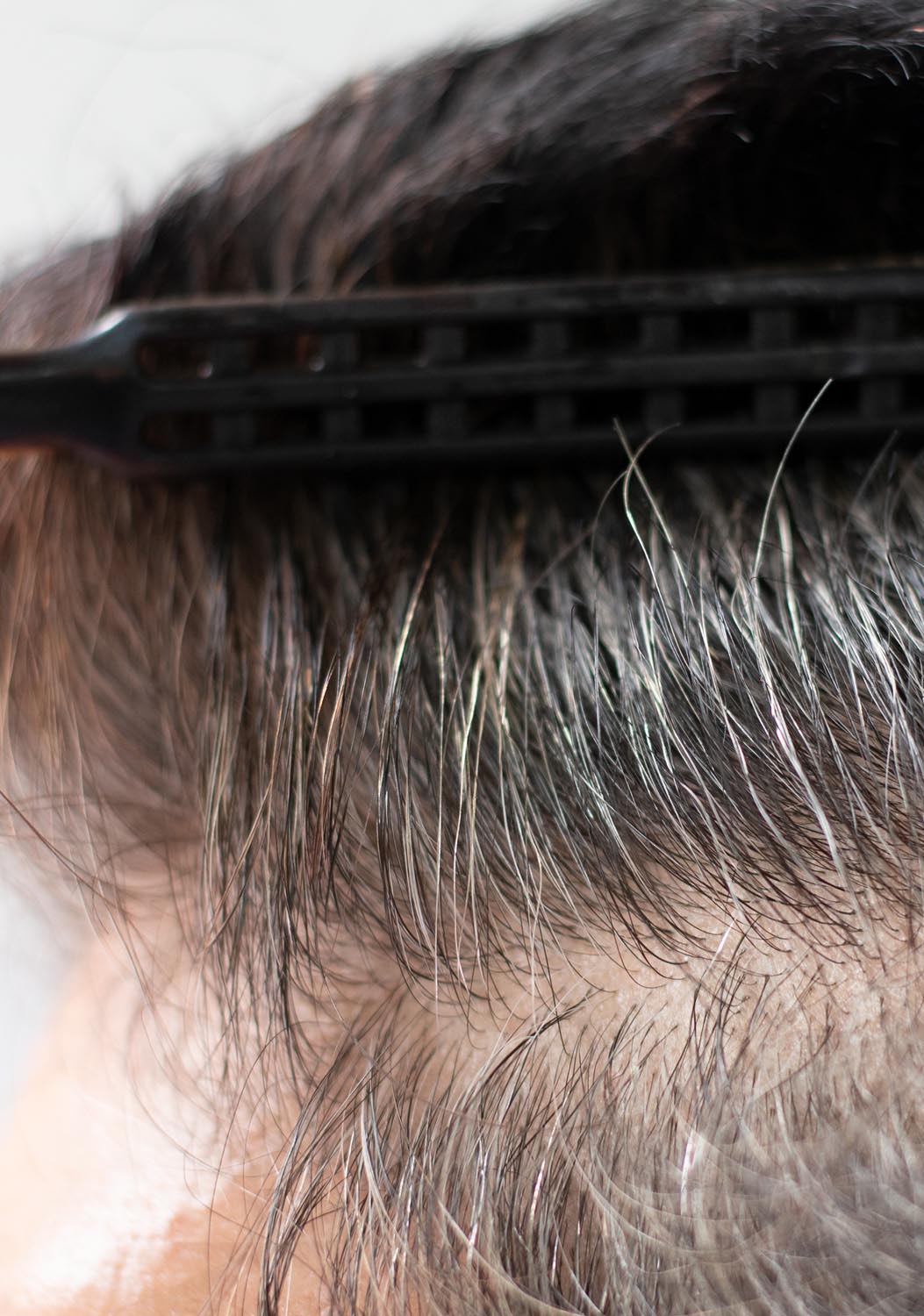 Scarless Hair Restoration - FUE Toronto Scarless Hair Restoration - FUE Toronto