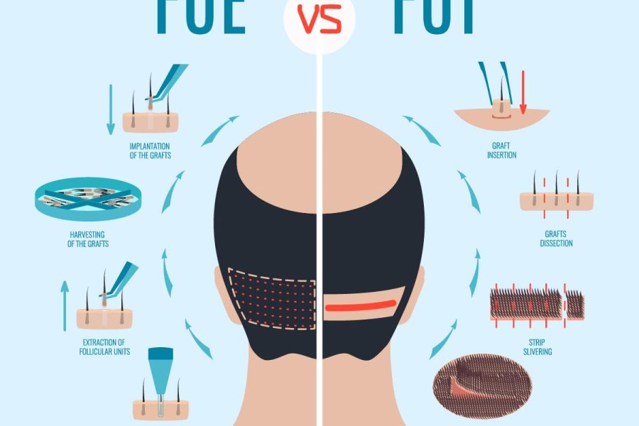 FUE vs. FUT Hair Transplants: An Overview