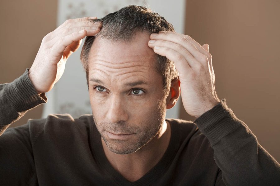FUE Hair Transplants Plus 9 Other Ways to Combat Baldness