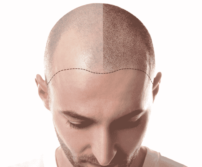 Skalp - Scalp Micropigmentation (Hair Loss Tattoo) You choose your perfect  hairline and look like you have a shaved head instead of a bald head, then  forget about hair loss. | Facebook