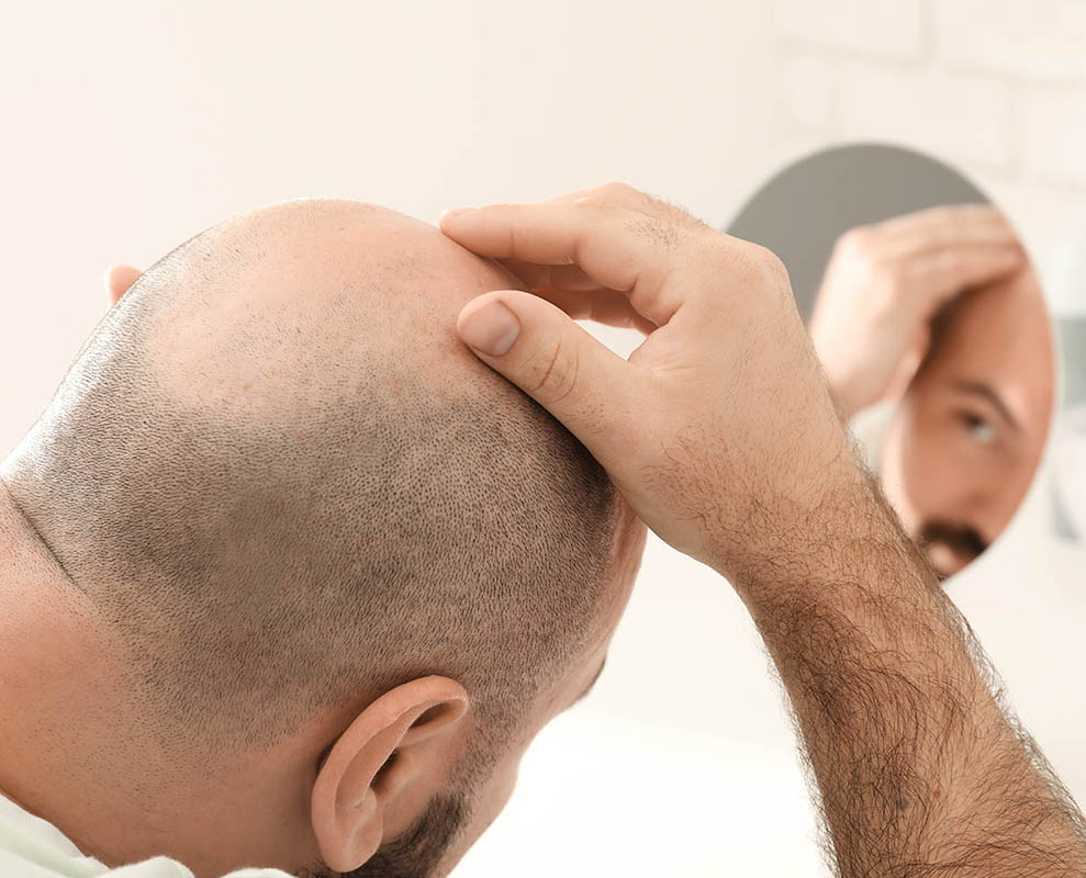 Hair Transplant Richmond Hill At The Toronto Hair Transplant Clinic