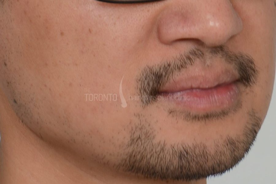 Beard Hair Transplant Toronto Patient 37