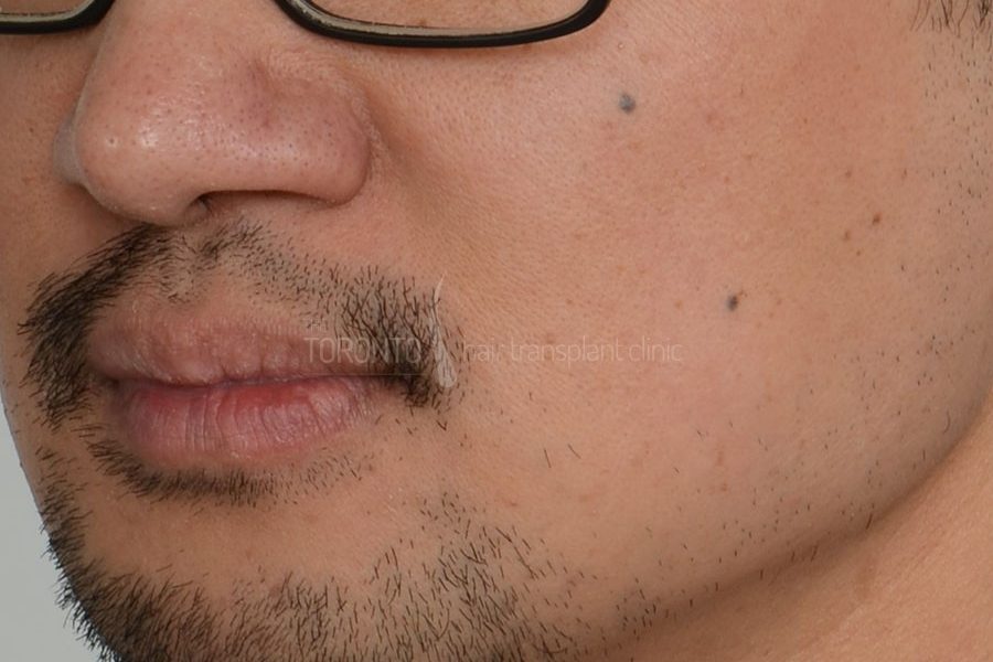 Beard Hair Transplant Toronto Patient 37