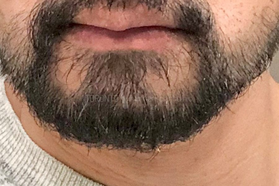 Beard Hair Transplant Toronto Patient 37